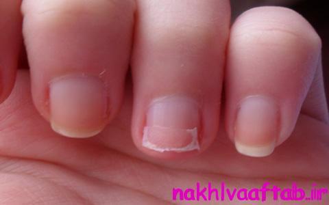 Cracked-or-Weak-Nails